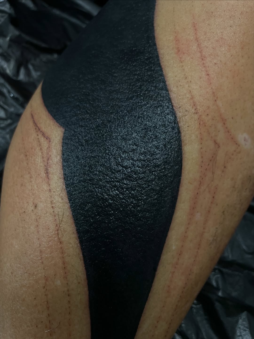Large solid black tattoo covering the front and side of the thigh, with visible red scar tissue on the surrounding natural skin.